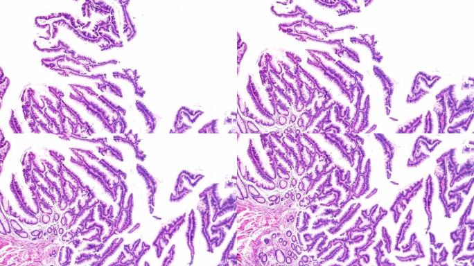 肠道腺瘤病人显微镜下病理标本