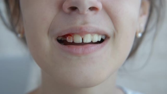 一个拔掉牙齿的孩子。