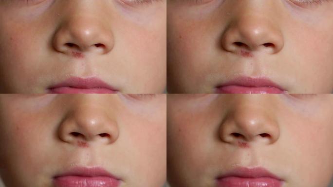 一个鼻子被划伤的小男孩的特写脸。