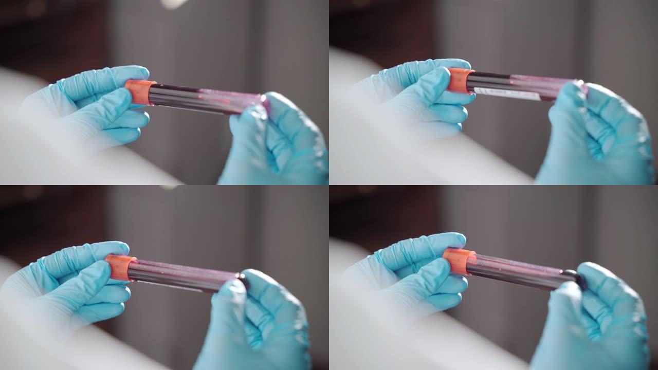 血液试管在医生的手中新型冠状病毒肺炎阳性结果，微生物学手在保护手套上的特写冠状病毒感染者的血管。实验