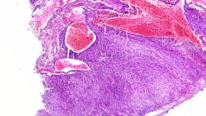 显微镜下的生物纤维肉瘤