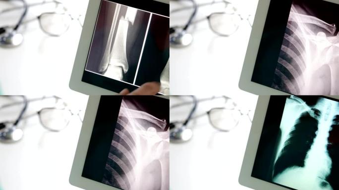 医生使用带有x射线结果的数字平板电脑