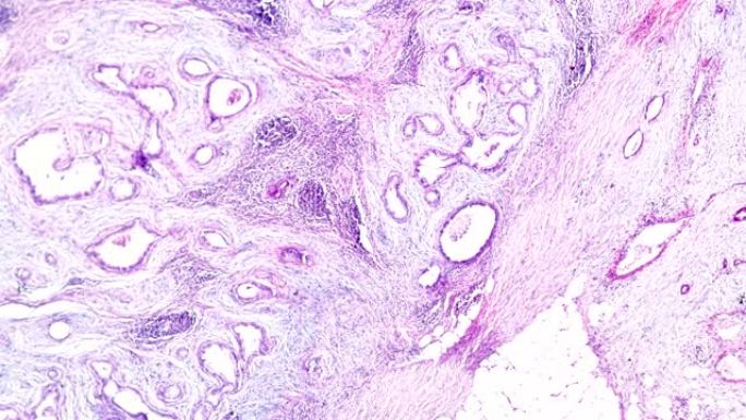 光镜下高分化腺癌微生物医疗医院