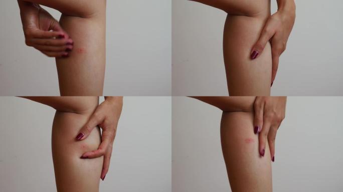 特写-昆虫咬女人的腿。