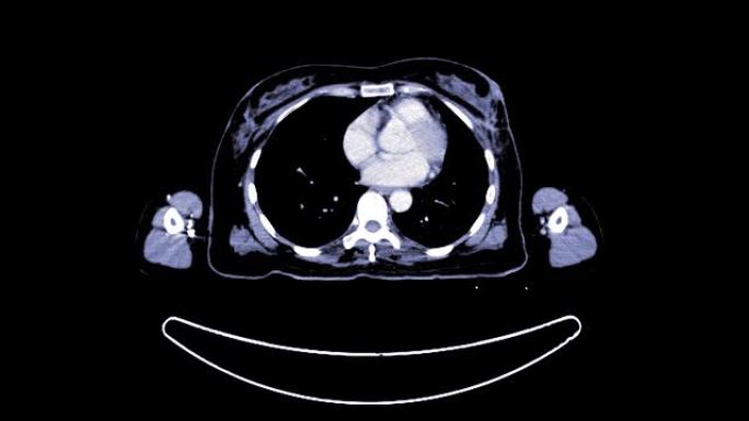 注射造影剂对人体轴向进行ct扫描。