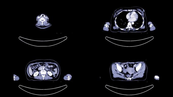 注射造影剂对人体轴向进行ct扫描。