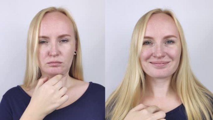 女性的第二次下巴提升。整形手术、心理成形术或面部建筑前后的照片。下巴脂肪去除和面部轮廓校正