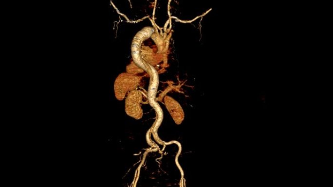 CTA整个主动脉3D渲染图像在屏幕上显示主动脉夹层。