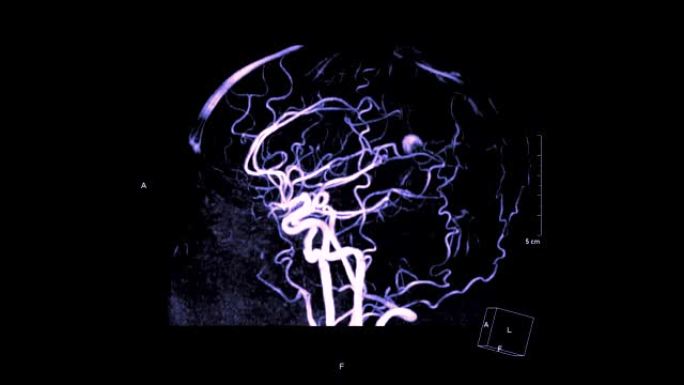 MRA脑或磁共振血管造影在屏幕上从右向左旋转以评估脑动脉疾病。