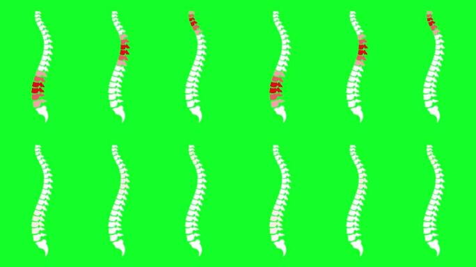 脊柱疼痛位于红色。脊柱疼痛闪烁动画