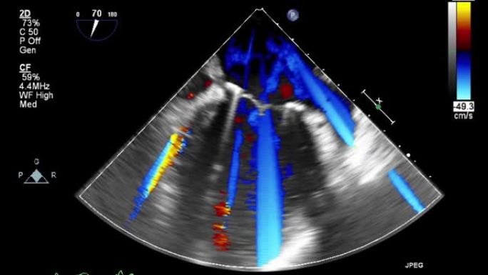 高质量视频超声经食管心脏检查。