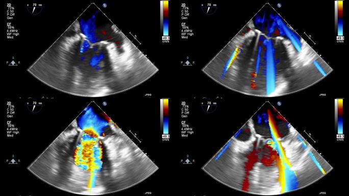 高质量视频超声经食管心脏检查。