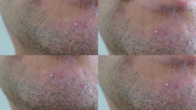 男性脸上发炎的痤疮，人的下巴部位发炎的痤疮，人类的痤疮问题，