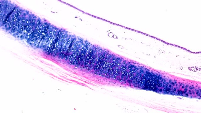 显微镜下不同区域的支气管粘膜鳞状化生