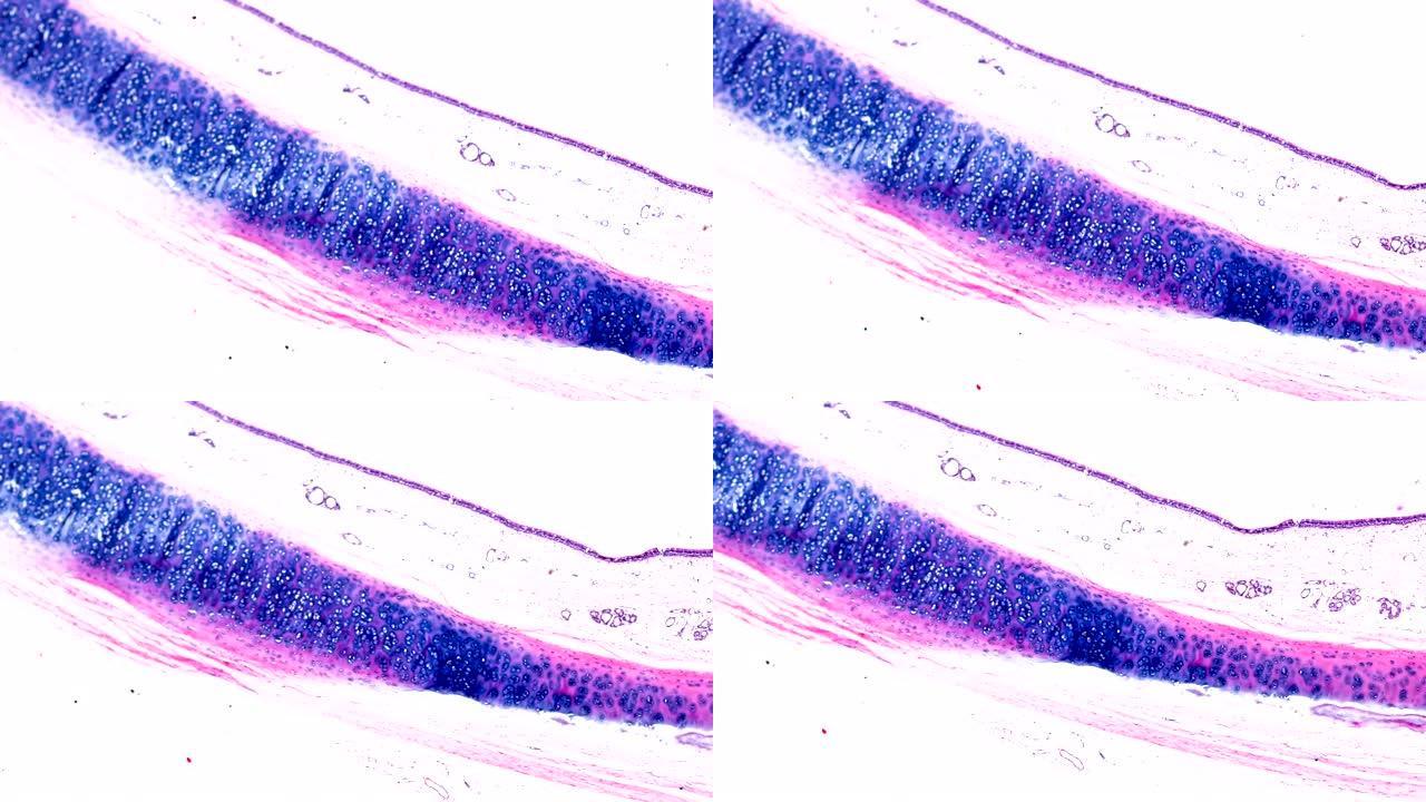 显微镜下不同区域的支气管粘膜鳞状化生