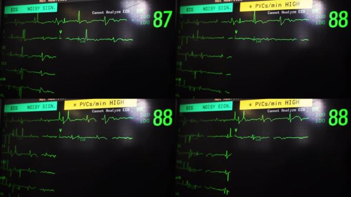 心电图警报心电图特写视频素材