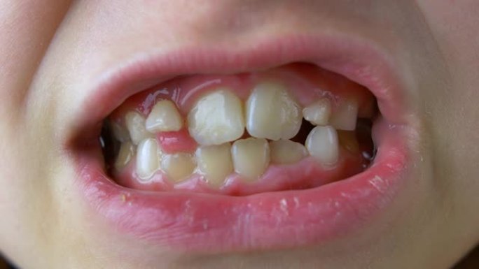 儿童松动的牙齿来回移动沉重