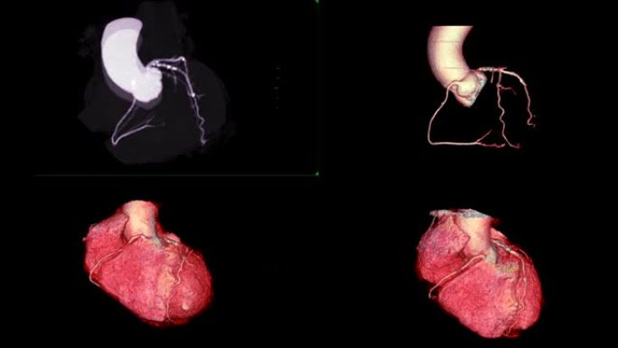 收集冠状动脉的CTA 3D渲染图像在屏幕上翻转，用于诊断冠状动脉疾病或CAD。