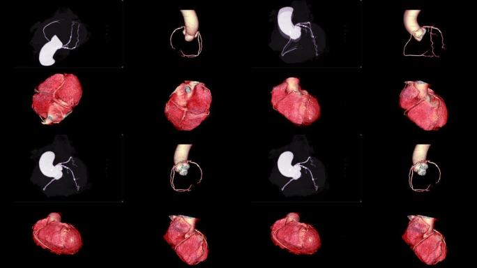 收集冠状动脉的CTA 3D渲染图像在屏幕上翻转，用于诊断冠状动脉疾病或CAD。