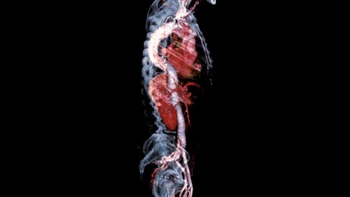 CTA全主动脉3D渲染图像在屏幕上带有骨骼透明转身，用于检测主动脉夹层。