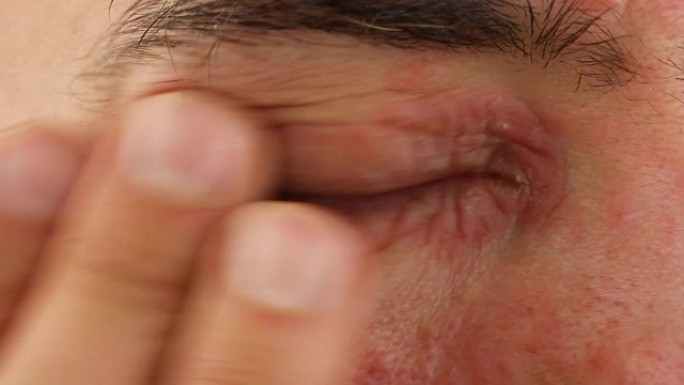 人体抓伤右眼有炎症和红色过敏反应，面部皮肤红肿和脱皮牛皮癣，季节性皮肤病学问题，特写宏观