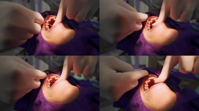 牙医用牙线在男人的嘴里清洁牙垢 (牙结石)