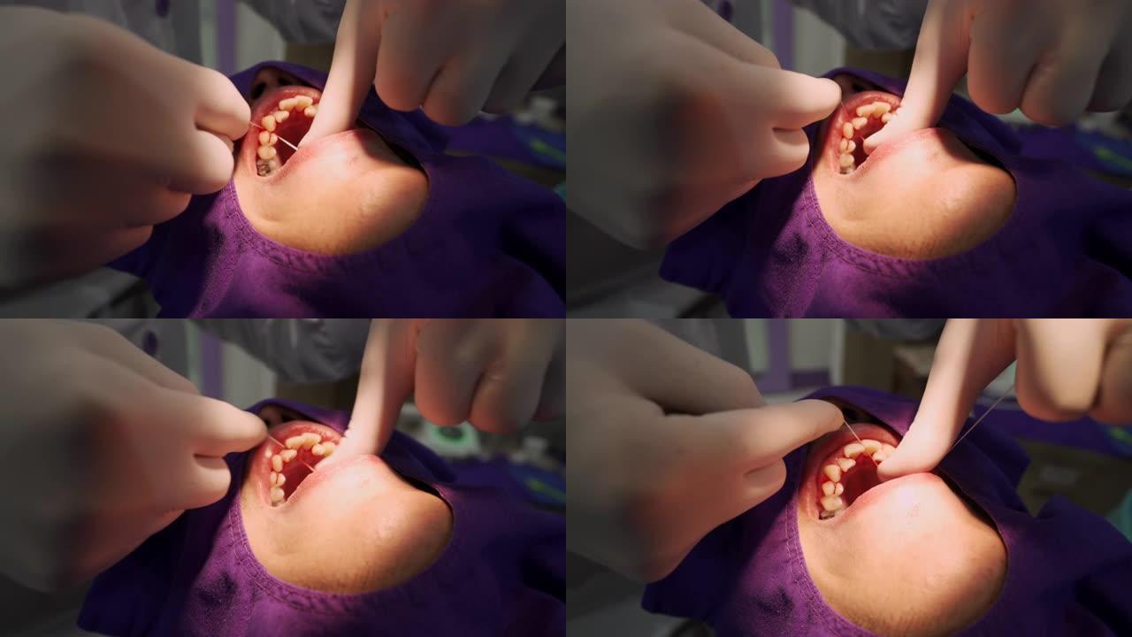 牙医用牙线在男人的嘴里清洁牙垢 (牙结石)