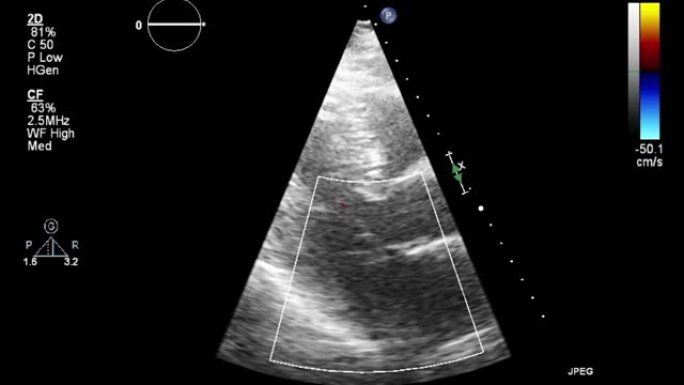 高质量视频超声经食管心脏检查。