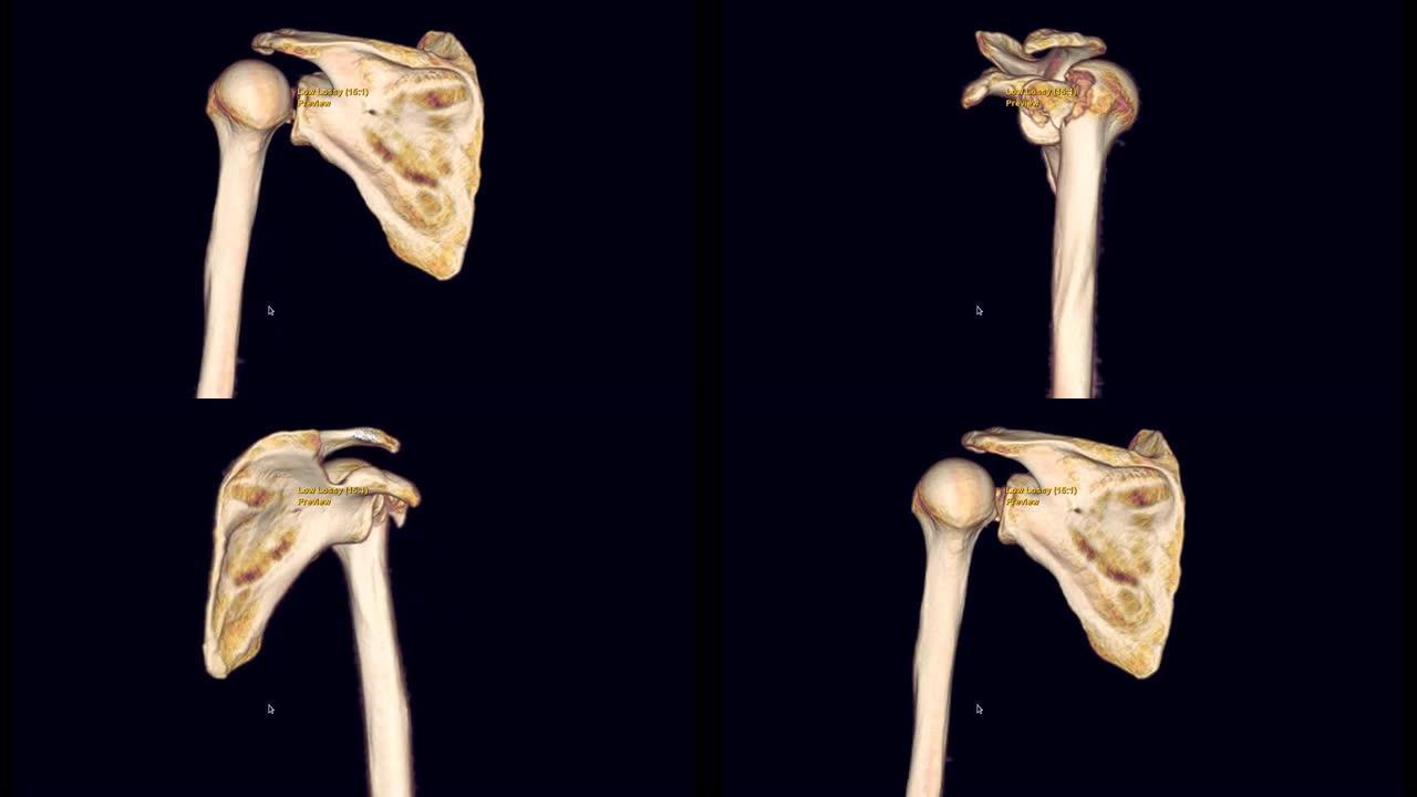 左肩ct扫描三维渲染显示肱骨头骨折。