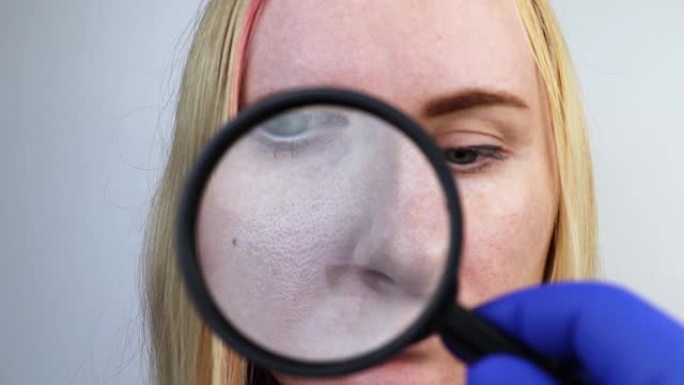 脸颊上的毛孔增大，黑斑，痤疮，酒渣鼻特写。一名妇女正在接受医生检查。皮肤科医生通过放大镜，放大镜检查
