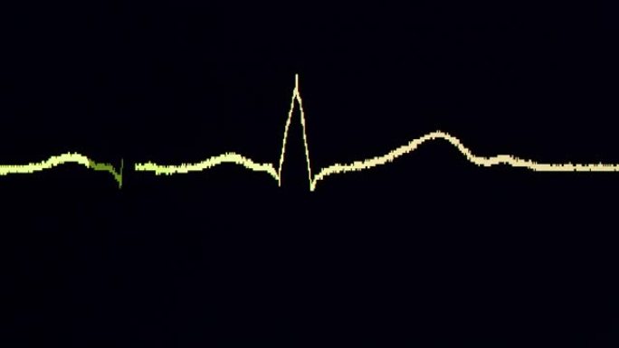 心电图波形心动心跳视频素材
