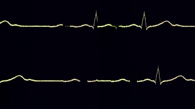 心电图波形心动心跳视频素材