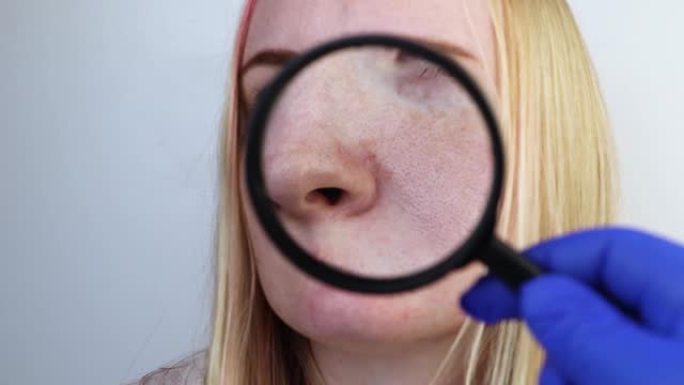 扩大的酒渣鼻，毛孔，黑斑，痤疮特写在鼻子。一名妇女正在接受医生检查。皮肤科医生通过放大镜，放大镜检查