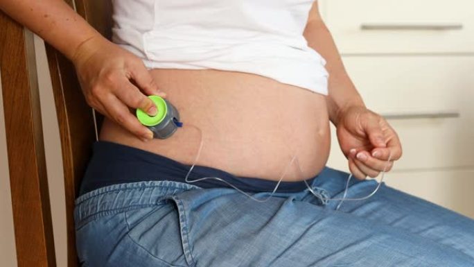 孕妇安装胰岛素泵引流，现代糖尿病治疗