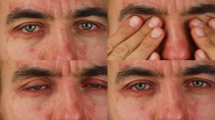 人类抓伤两只眼睛有红色过敏反应，面部皮肤红肿和脱皮牛皮癣，季节性皮肤病学问题，特写