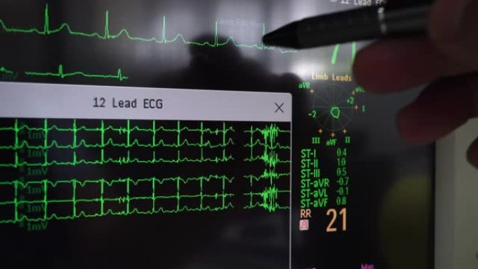 心电图波形心电图分析急诊室