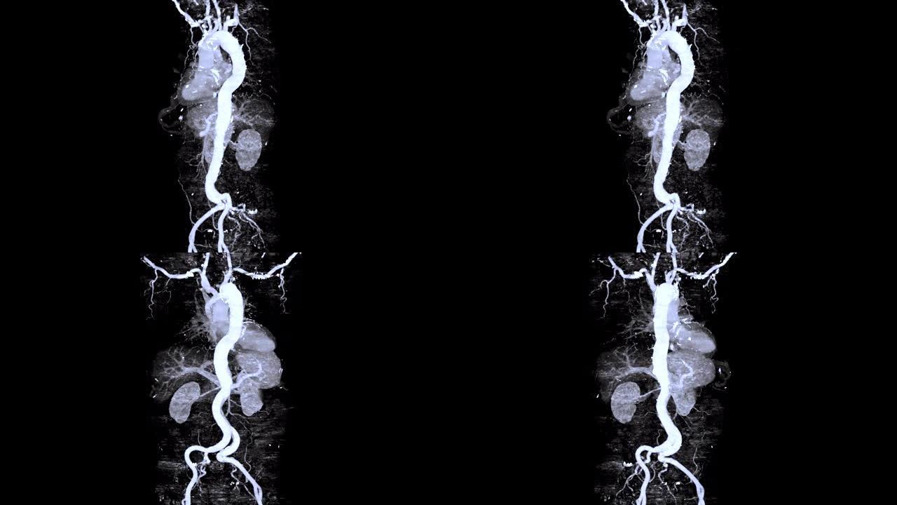 CTA整个主动脉3D渲染图像在屏幕上显示主动脉夹层。