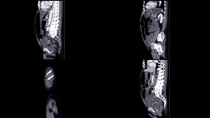 CT全腹部，造影剂矢状面显示肠梗阻。