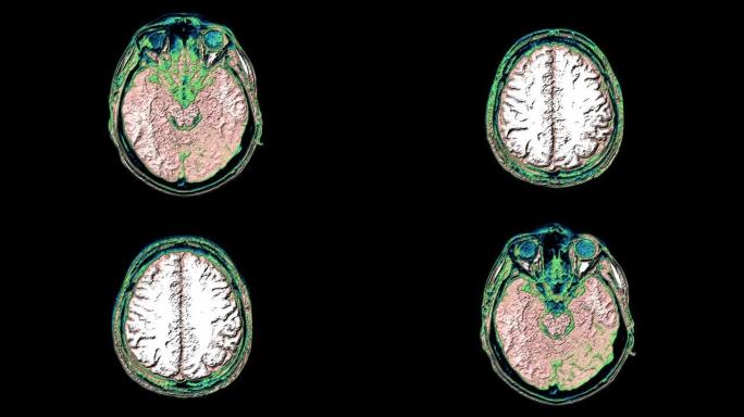 对大脑和头部进行大量彩色MRI扫描，以检测肿瘤。诊断医疗工具