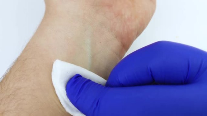 一位戴着蓝色医用手套的医生用医用酒精夹住棉绒，擦拭他将要采血进行分析的地方。采血用皮肤消毒。