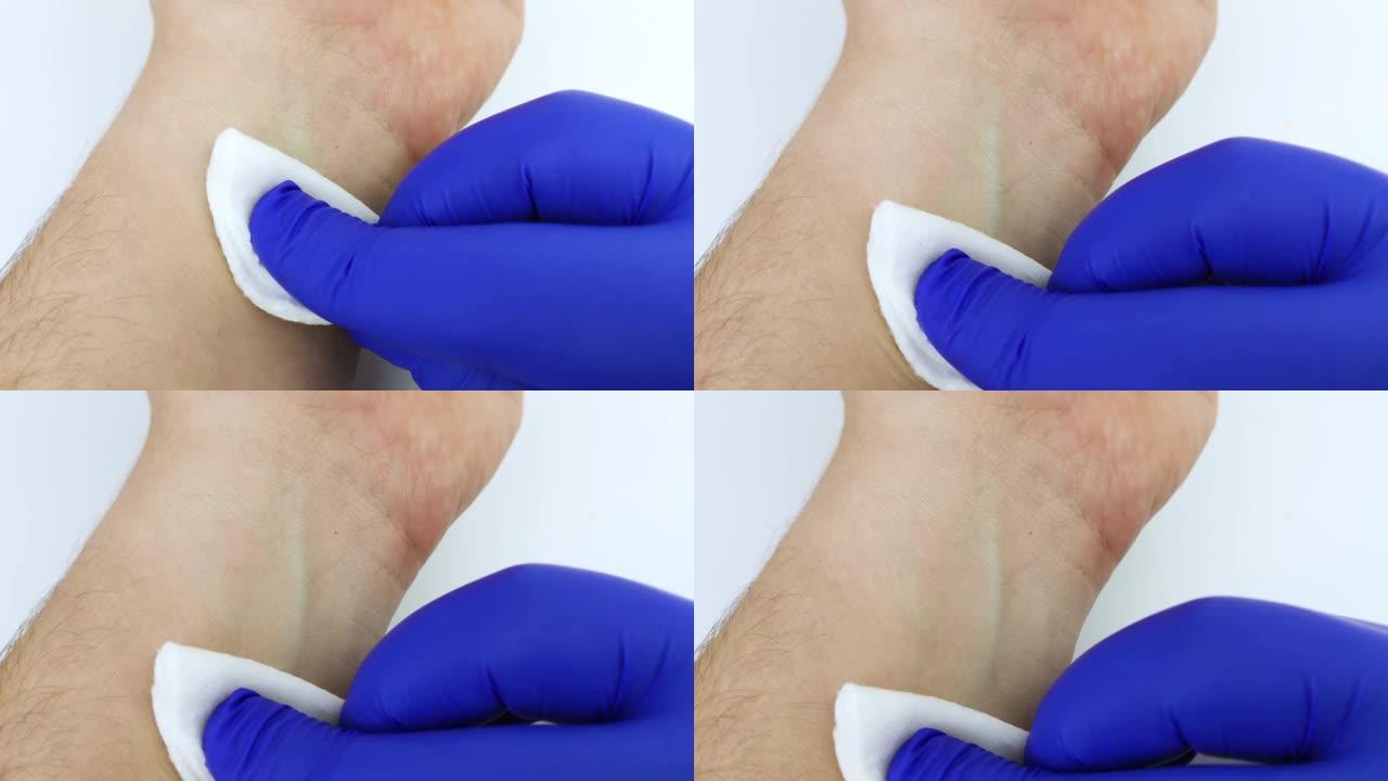 一位戴着蓝色医用手套的医生用医用酒精夹住棉绒，擦拭他将要采血进行分析的地方。采血用皮肤消毒。