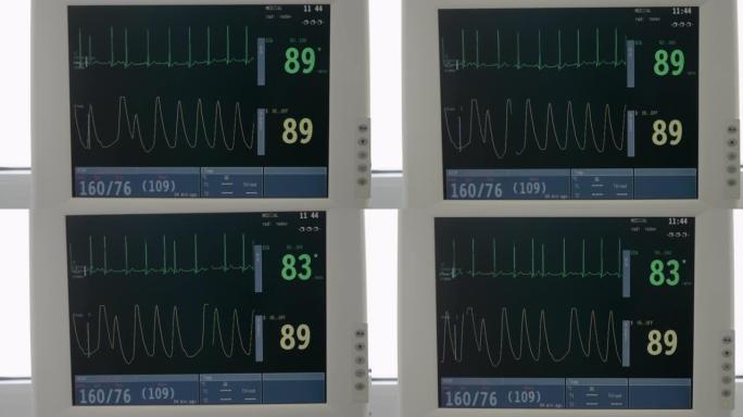 医院。CU，ESG监视器。生命体征监视器显示波形心电图。急诊室。