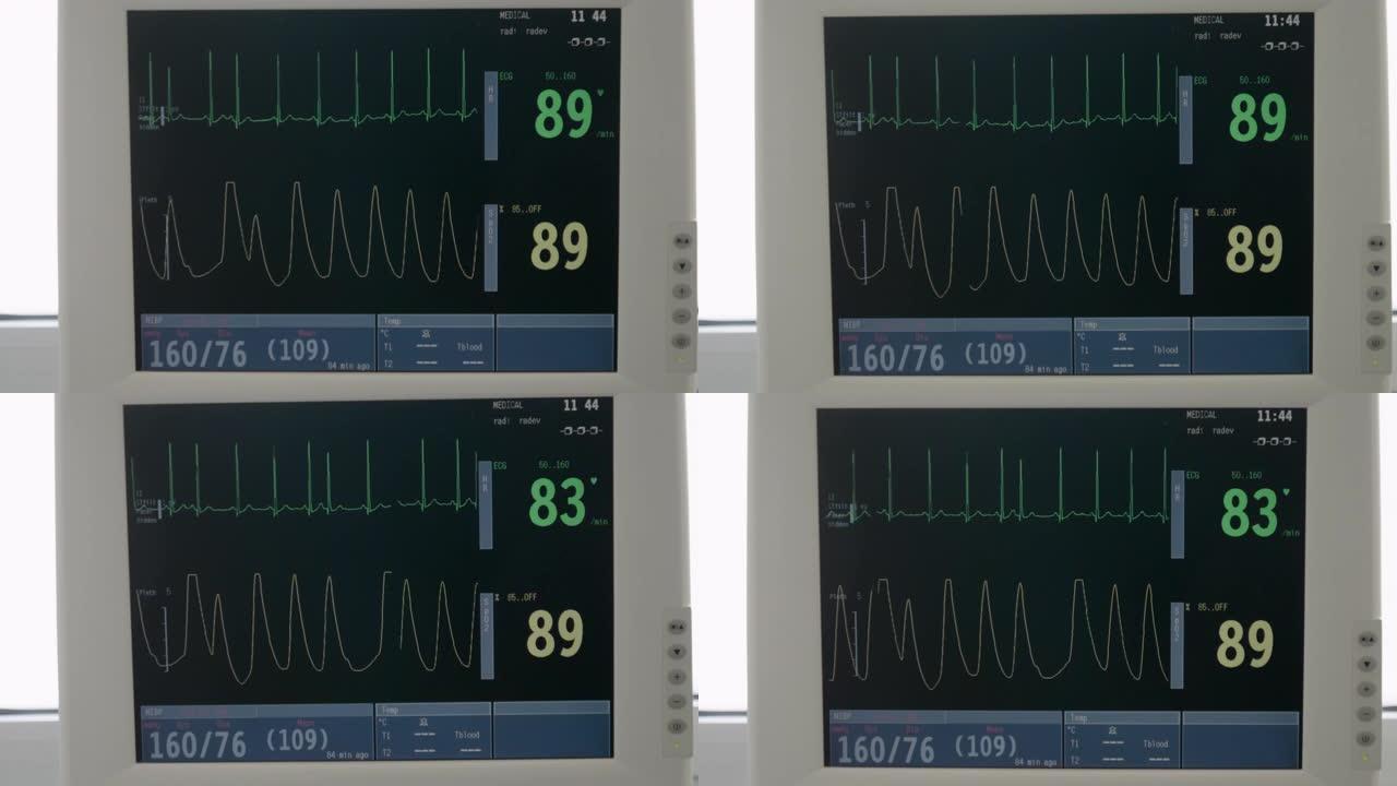 医院。CU，ESG监视器。生命体征监视器显示波形心电图。急诊室。