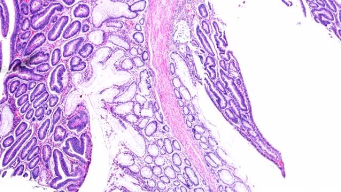 显微镜下不同区域的大肠癌 (不同管状腺癌)