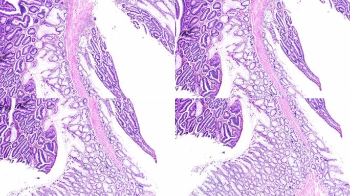 显微镜下不同区域的大肠癌 (不同管状腺癌)