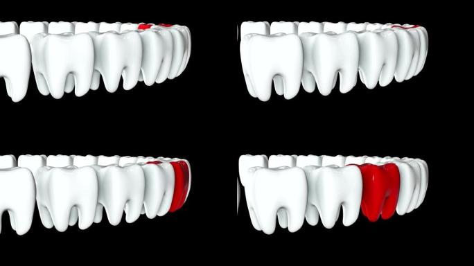 一排白色牙齿中的红牙。3D渲染。牙科，出众，经营理念。