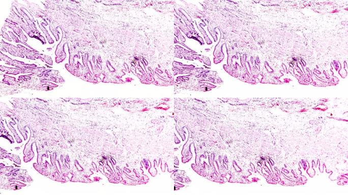 显微镜下的慢性胆囊炎人体病理样本