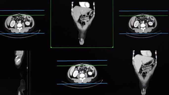 整个腹部的ct扫描或计算机断层扫描