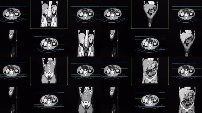 整个腹部的ct扫描或计算机断层扫描