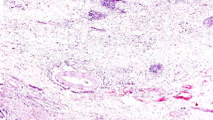 显微镜下的慢性胆囊炎人体病理样本